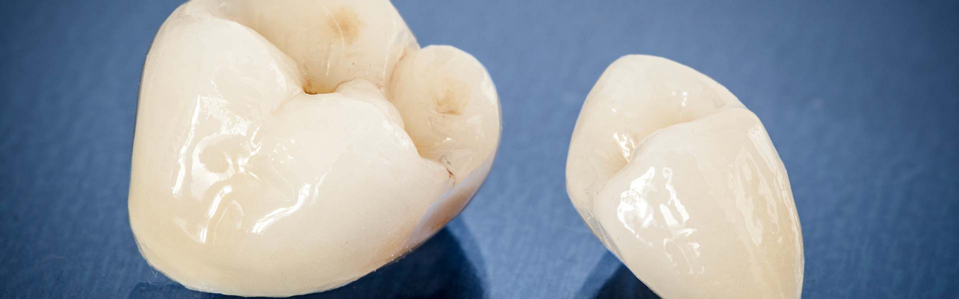 Dental Crowns In Red Deer - Dental Bridges Ab 